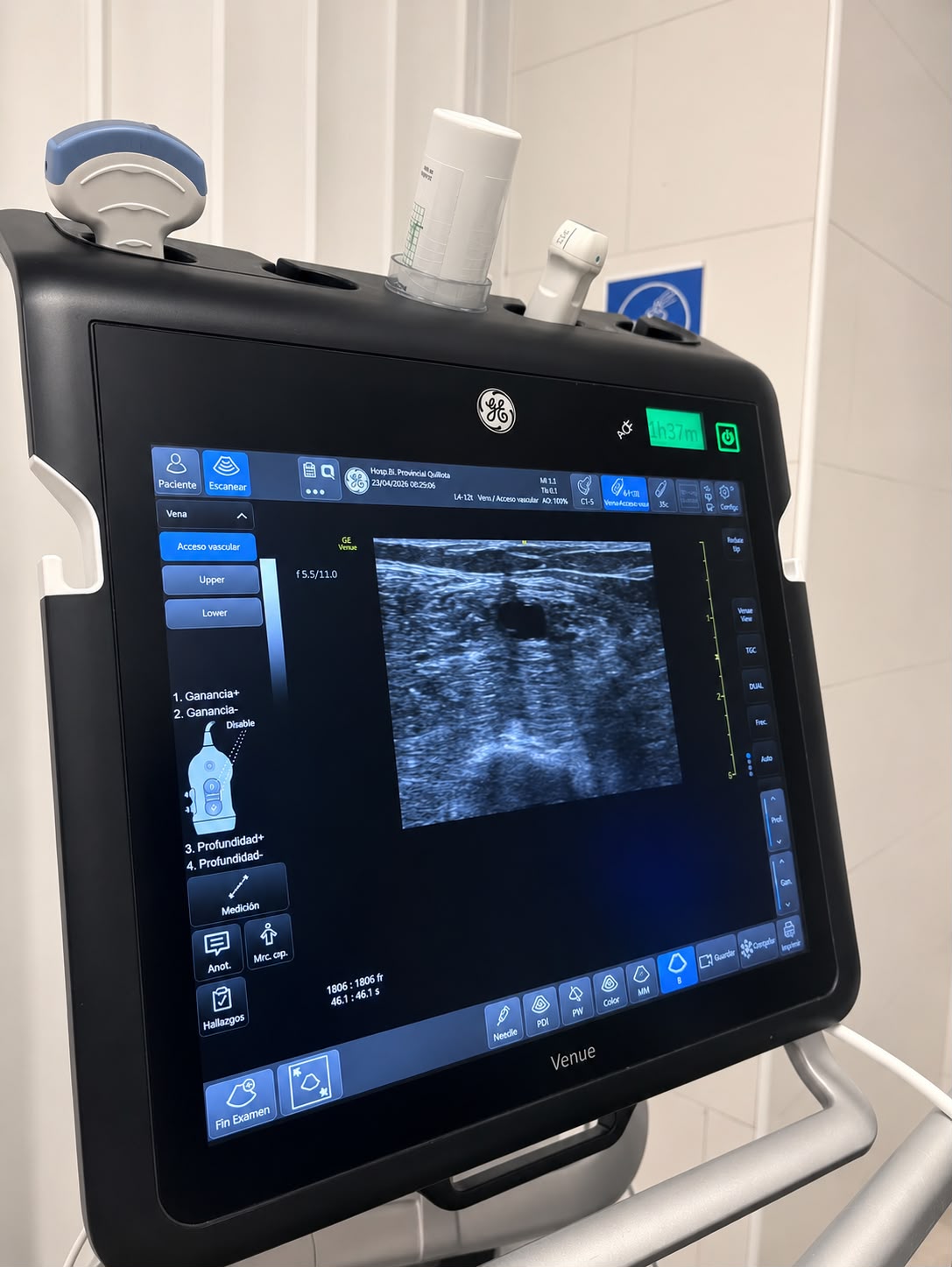 Pantalla del ec&oacute;grafo GE Venue mostrando la vena en eje corto como estructura anecoica